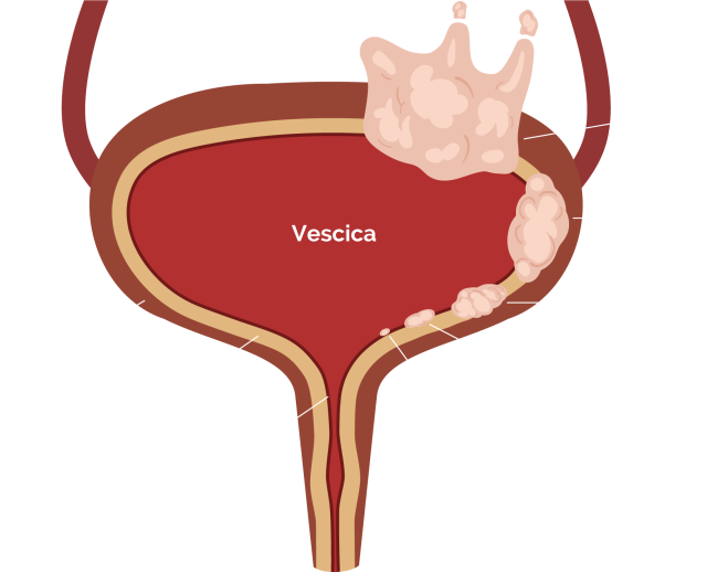 Illustrazione anatomica della vescica urinaria con rappresentazione visiva dei diversi stadi del tumore alla vescica